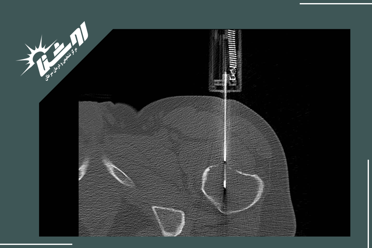دلایل انتخاب مرکز روشنا برای انجام نمونه برداری تحت هدایت سی تی اسکن