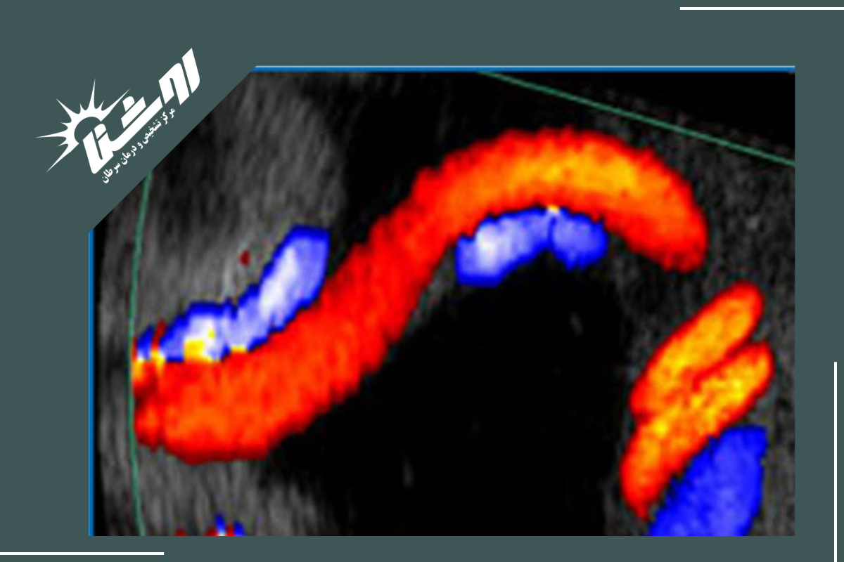 سونوگرافی داپلر چیست؟