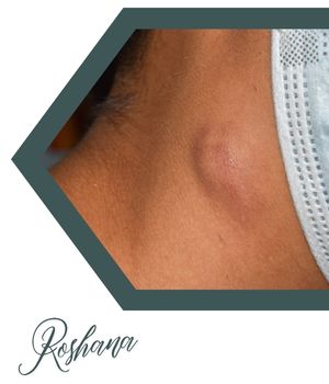 دلایل نیاز به نمونه برداری از غدد لنفاوی دلایل نیاز به نمونه برداری از غدد لنفاوی