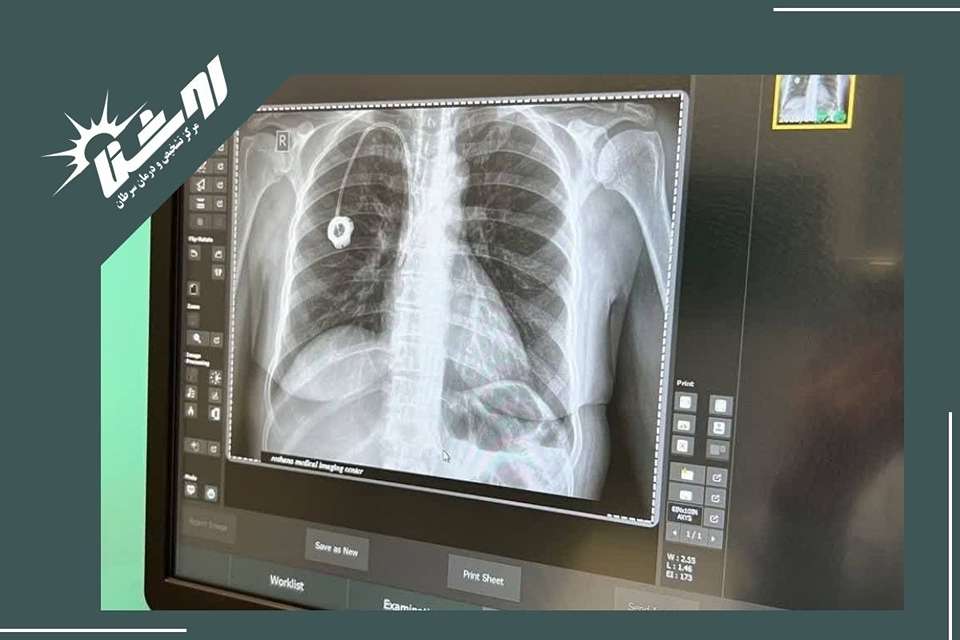 مقایسه با گرافی ساده