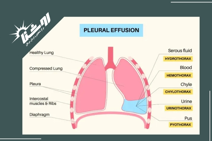 تشخیص آب آوردن ریه (پلورال افیوژن) با سونوگرافی تشخیص آب آوردن ریه (پلورال افیوژن) با سونوگرافی