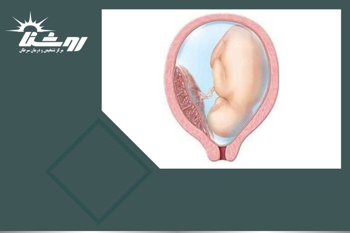آیا جفت پایین در بارداری خطرناک است و چگونه تشخیص داده می‌شود؟