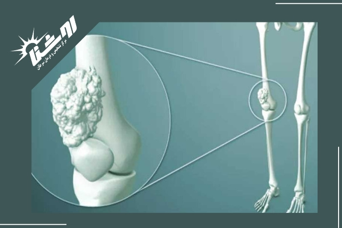 آیا درد استخوان علامت سرطان است؟