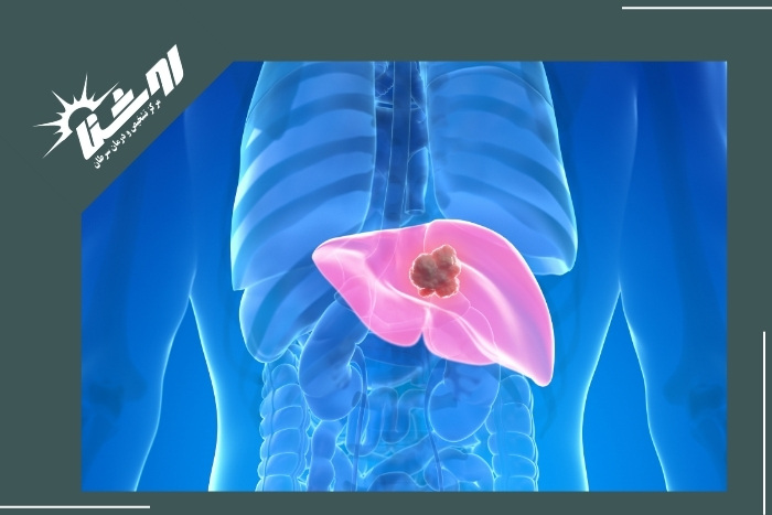 ارتباط تجمع آهن در کبد و سرطان ارتباط تجمع آهن در کبد و سرطان