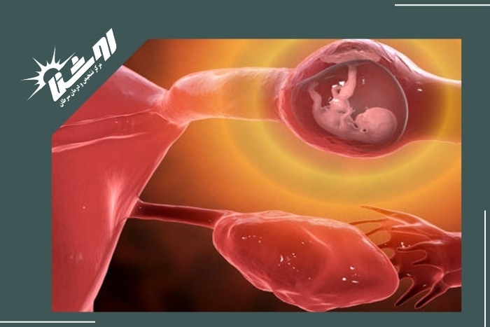 اهمیت تشخیص زودهنگام بارداری خارج رحمی