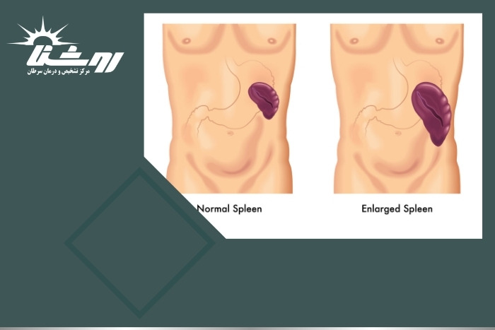 بزرگ شدن طحال در سونوگرافی چه معنایی دارد و آیا خطرناک است؟