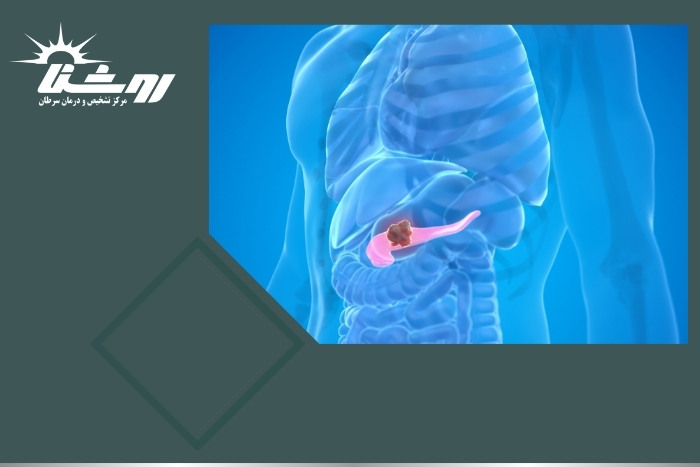 بهترین راه تشخیص سرطان پانکراس چیست؟