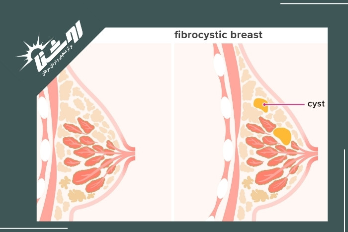 تاثیر فیبروکیستیک شدن پستان بر سلامت زنان تاثیر فیبروکیستیک شدن پستان بر سلامت زنان