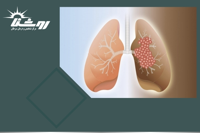 آیا فیبروز ریوی برای تشخیص نیاز به نمونه برداری دارد؟