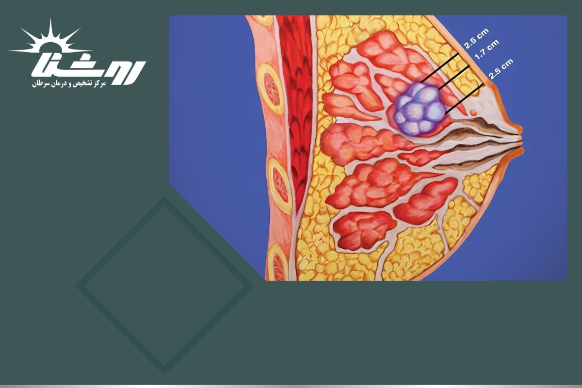 آیا توده‌های سفت در سینه لزوما سرطانی هستند؟