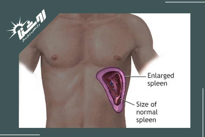 خطر بزرگ شدن طحال در سونوگرافی