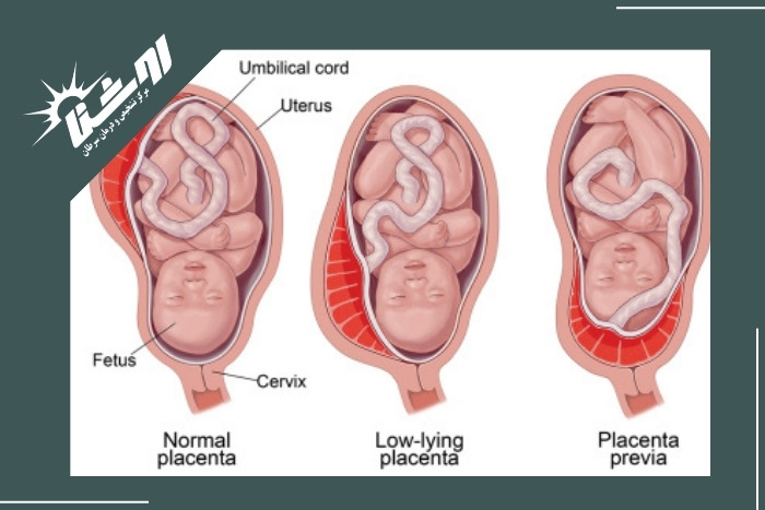 خطر جفت پایین در بارداری