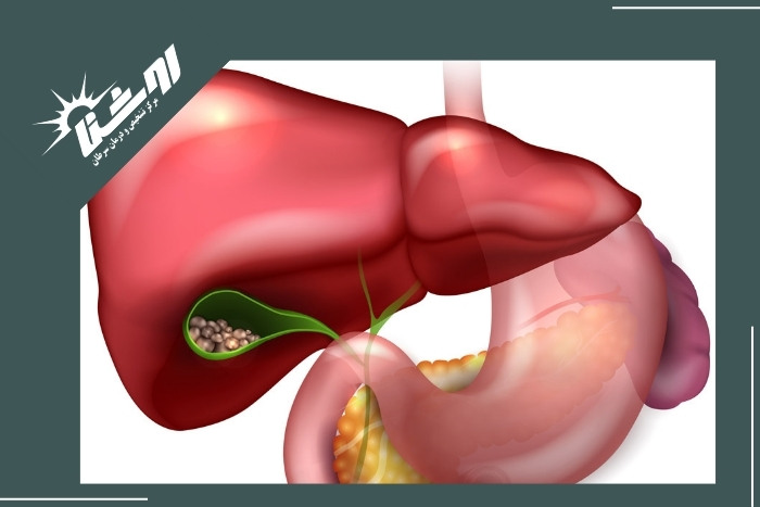 راهکارهای پیشگیری از ایجاد سنگ