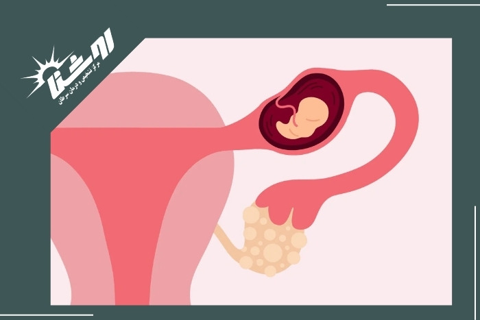 روش‌های تشخیص حاملگی خارج از رحمی