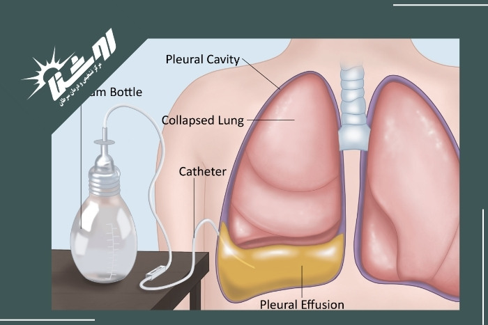 روش‌های درمان پلورال افیوژن