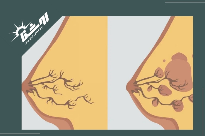 روش‌های پیشگیری و کاهش علائم