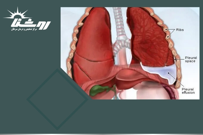 سونوگرافی چگونه در تشخیص آب آوردن ریه (پلورال افیوژن) کمک می‌کند؟