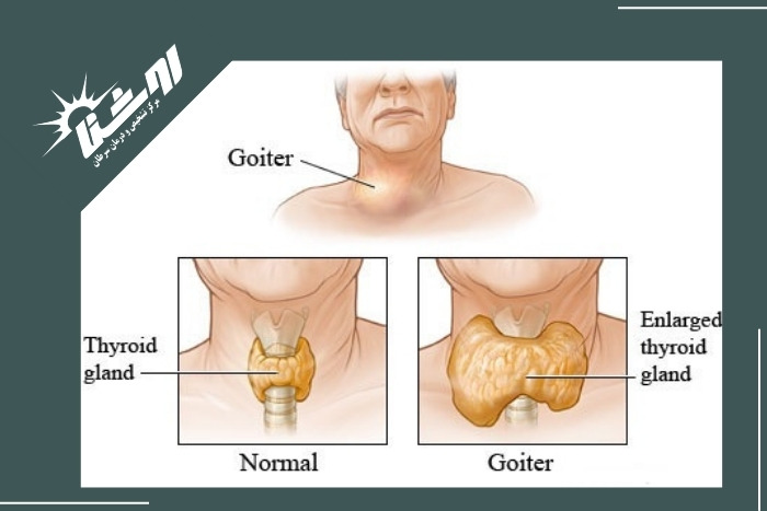 علائم بیماری گواتر و نیاز به بیوپسی