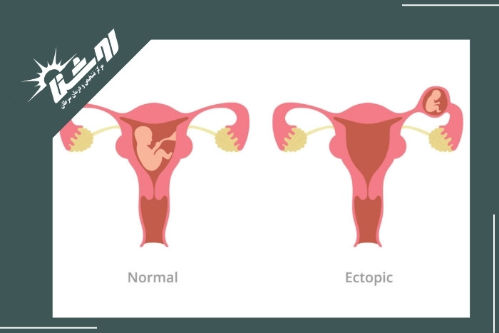 علائم بارداری خارج رحمی