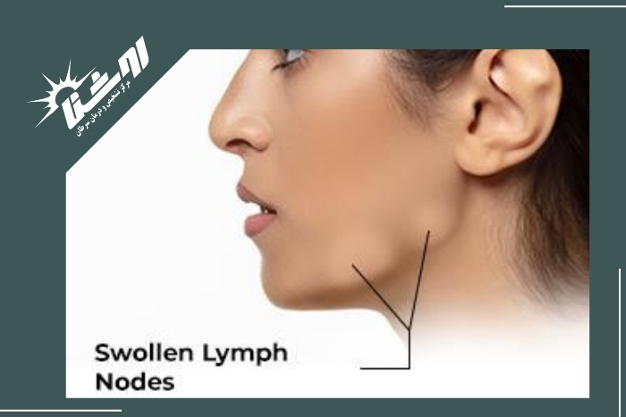 علائم خطرناک التهاب غدد لنفاوی علائم خطرناک التهاب غدد لنفاوی