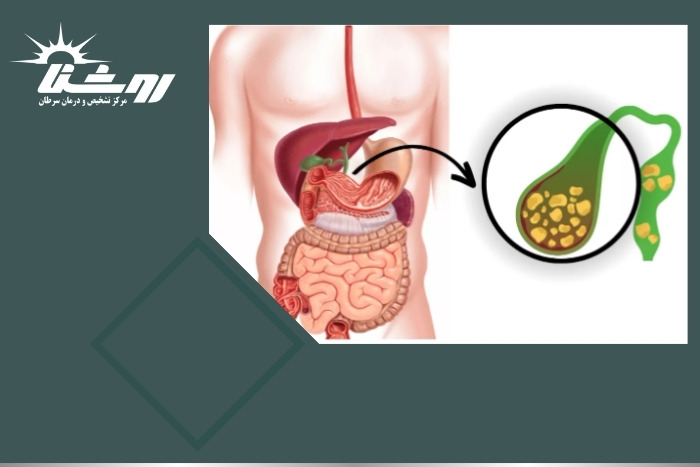 علائم سنگ کیسه صفرا و سونوگرافی چگونه به شناسایی آن کمک می‌کند؟