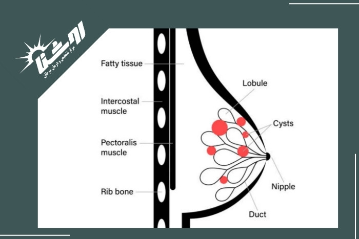 علت فیبروکیستیک شدن سینه علت فیبروکیستیک شدن سینه