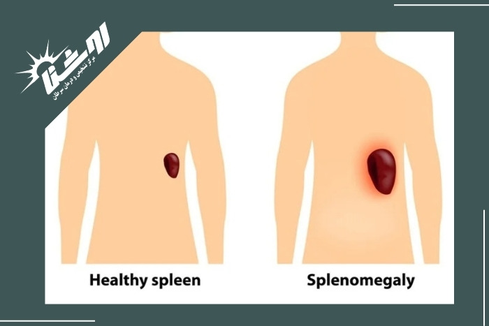 علت‌های بزرگ شدن طحال