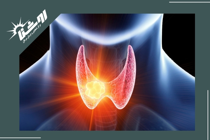 علل ایجاد ندول تیروئید