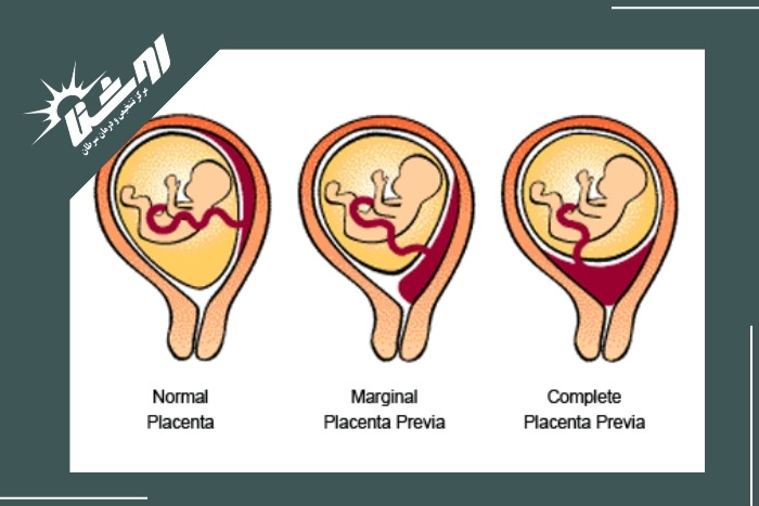 علل بروز این عارضه