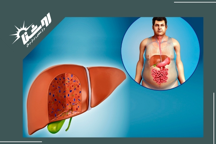 علل تجمع آهن در کبد علل تجمع آهن در کبد