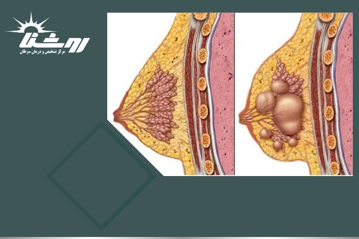 فیبروکیستیک شدن پستان چه تأثیری بر سلامت زنان دارد؟ فیبروکیستیک شدن پستان چه تأثیری بر سلامت زنان دارد؟