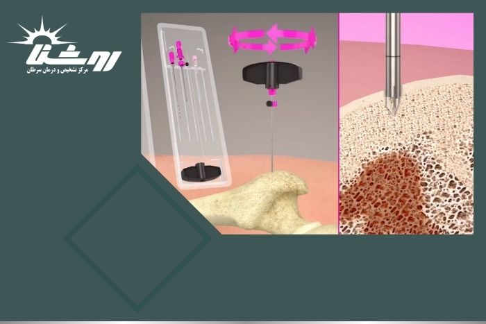 نمونه‌ برداری استخوان برای چیست و چگونه انجام می شود؟