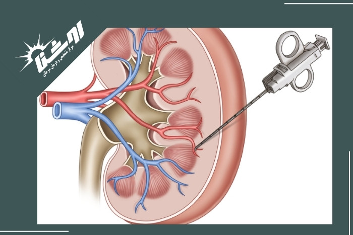 نمونه‌برداری کلیه و لگن چقدر درد دارد؟