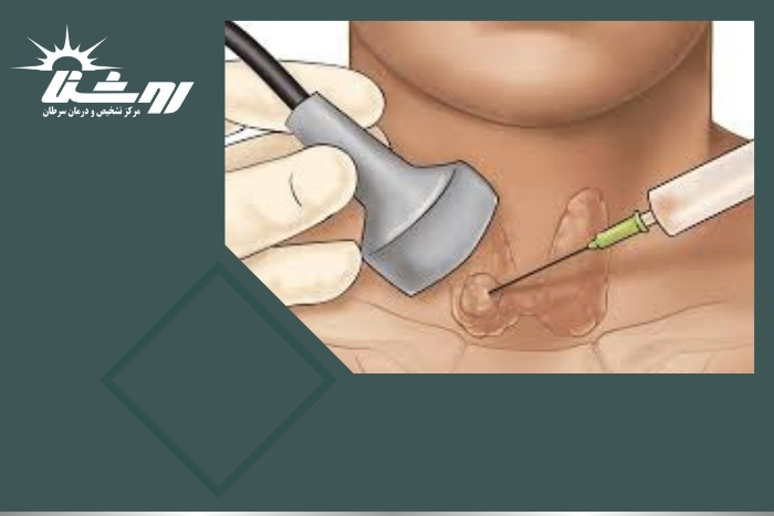 چه زمانی وجود گره در تیروئید نیاز به نمونه‌برداری دارد؟