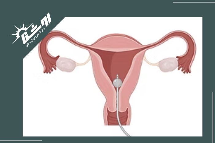 چه کسانی نیاز به هیستروسالپنگوگرافی دارند؟