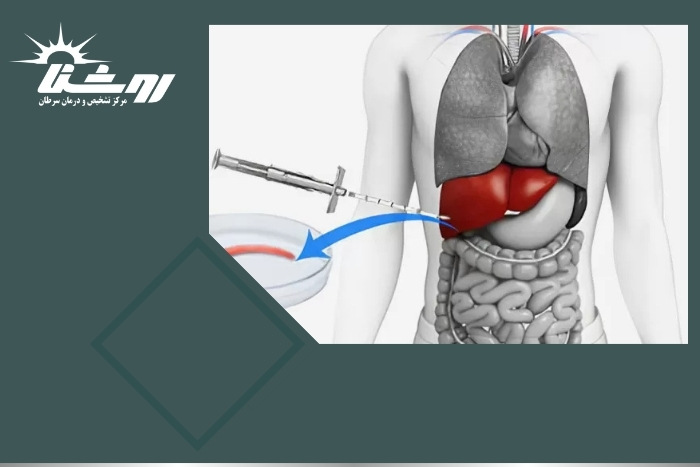 کبد پلی‌کیستیک چه تاثیری در بدن دارد؟ علائم و تشخیص آن