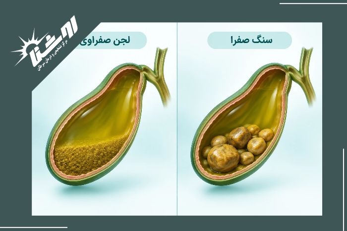 تفاوت لجن صفراوی و سنگ صفرا تفاوت لجن صفراوی و سنگ صفرا
