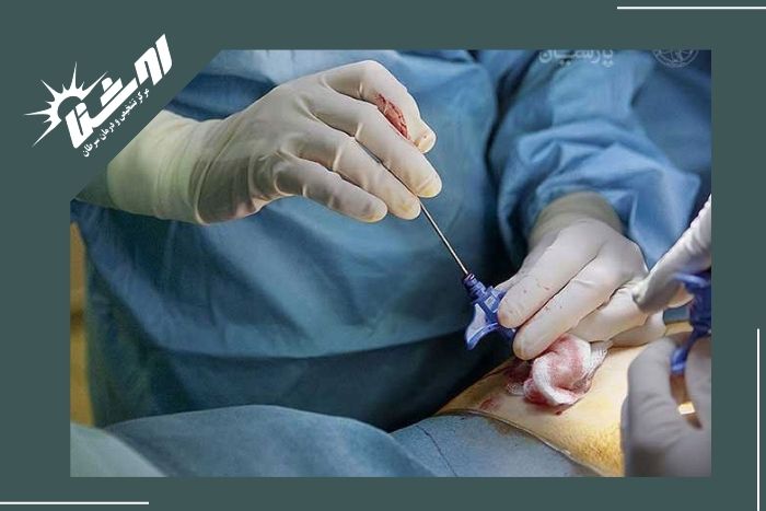 روش های بررسی و تشخیص توده‌های عمقی شکمی
